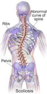 Scoliosis Contact Vital Force St Louis Chiropractor
