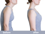 before and after of correct posture